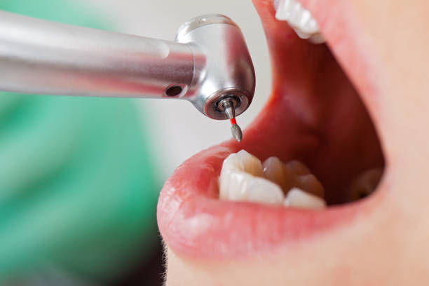Best Emergency Treatment for Dental Infections or Abscesses in Buffalo, NY